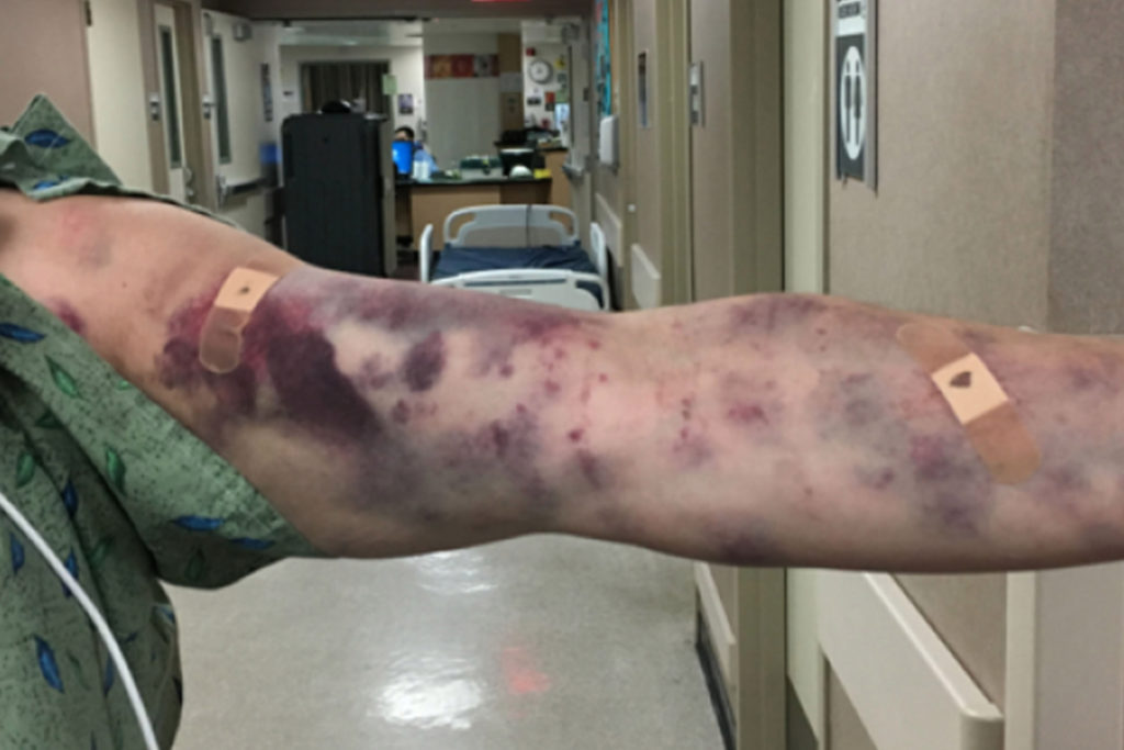 Mystery Bug Bite That Left Arizona Man In Bruises Gets Doctors Baffled